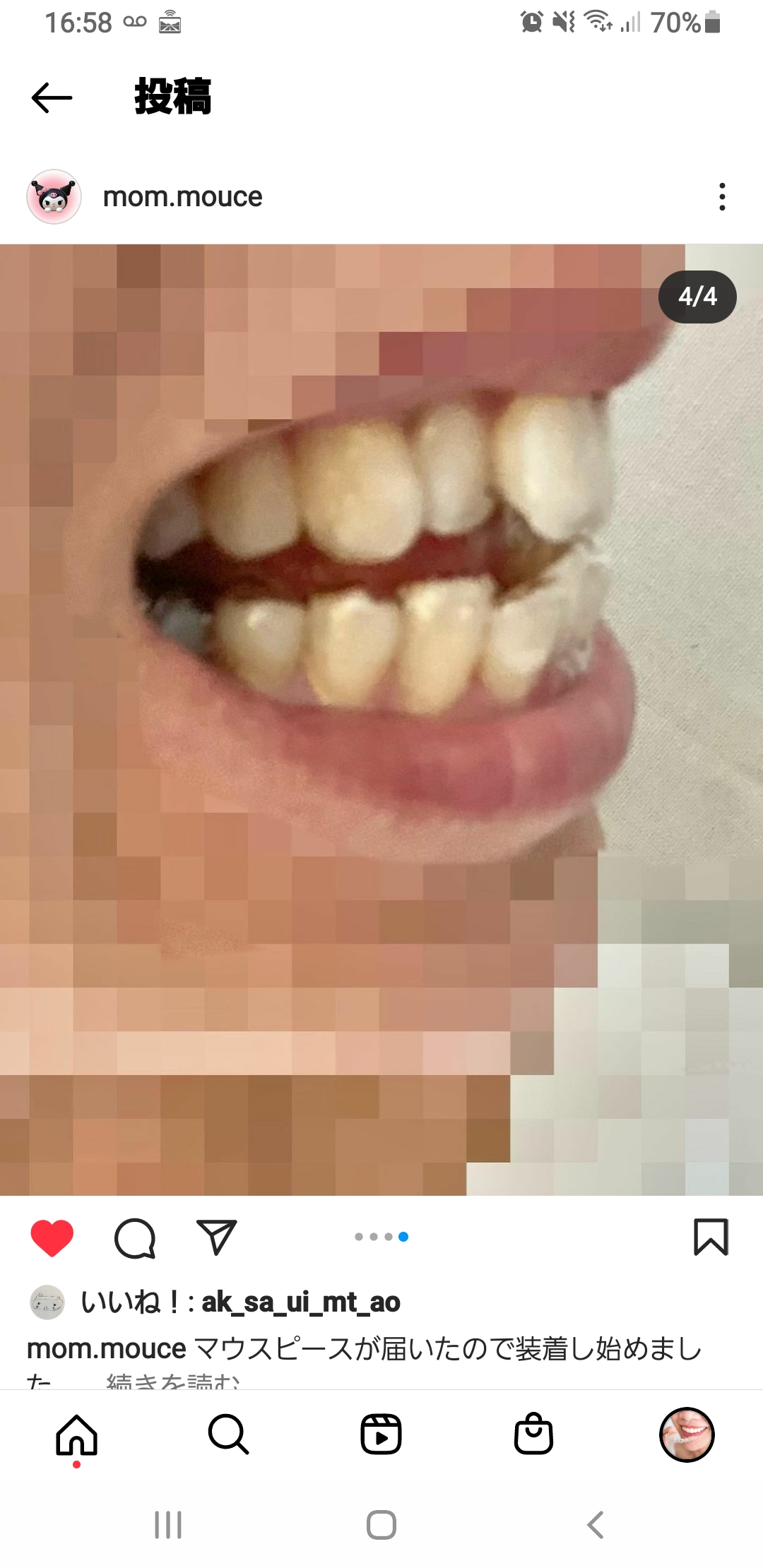 マウスピース届いたので装着し始めました
