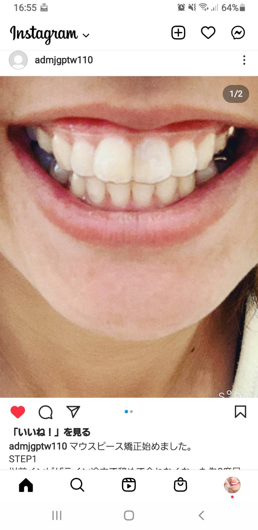 マウスピース矯正始めました